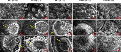 Corrigendum: Bullous pemphigoid IgG induces cell dysfunction and enhances the motility of epidermal keratinocytes via Rac1/proteasome activation
